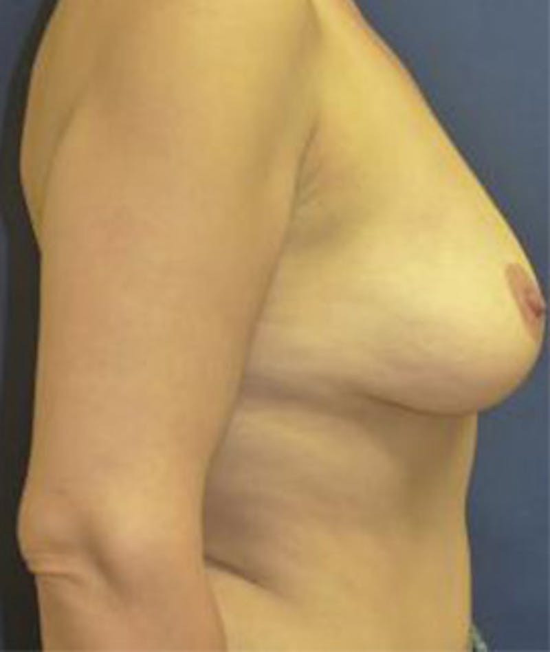Breast Augmentation Before & After Gallery - Patient 534431 - Image 3