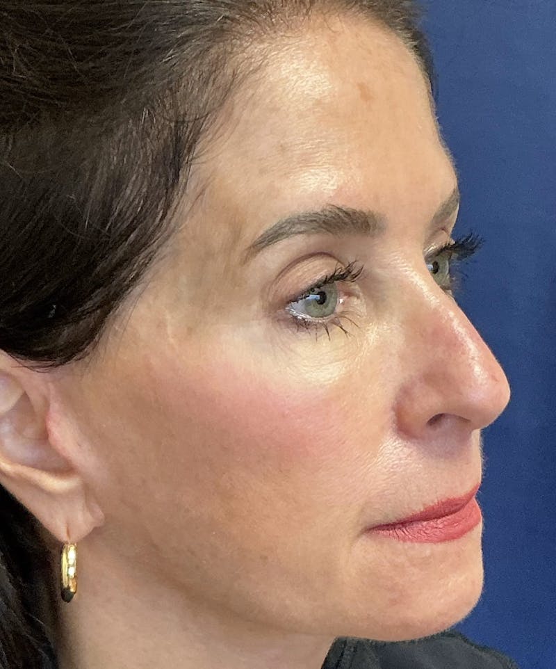 Rhinoplasty Before & After Gallery - Patient 226996 - Image 3