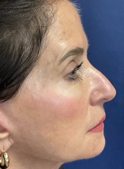 Rhinoplasty Before & After Gallery - Patient 226996 - Image 1