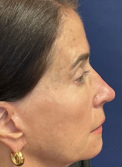 Rhinoplasty Before & After Gallery - Patient 226996 - Image 2