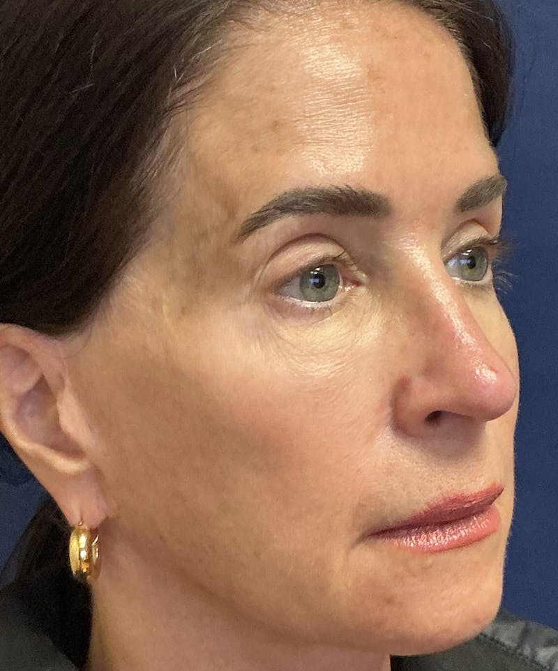 Rhinoplasty Before & After Gallery - Patient 226996 - Image 4