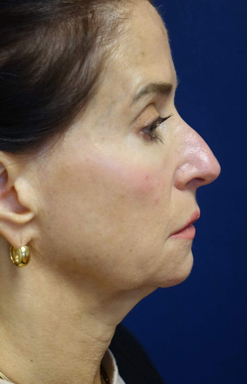 Facelift Before & After Gallery - Patient 268612 - Image 1