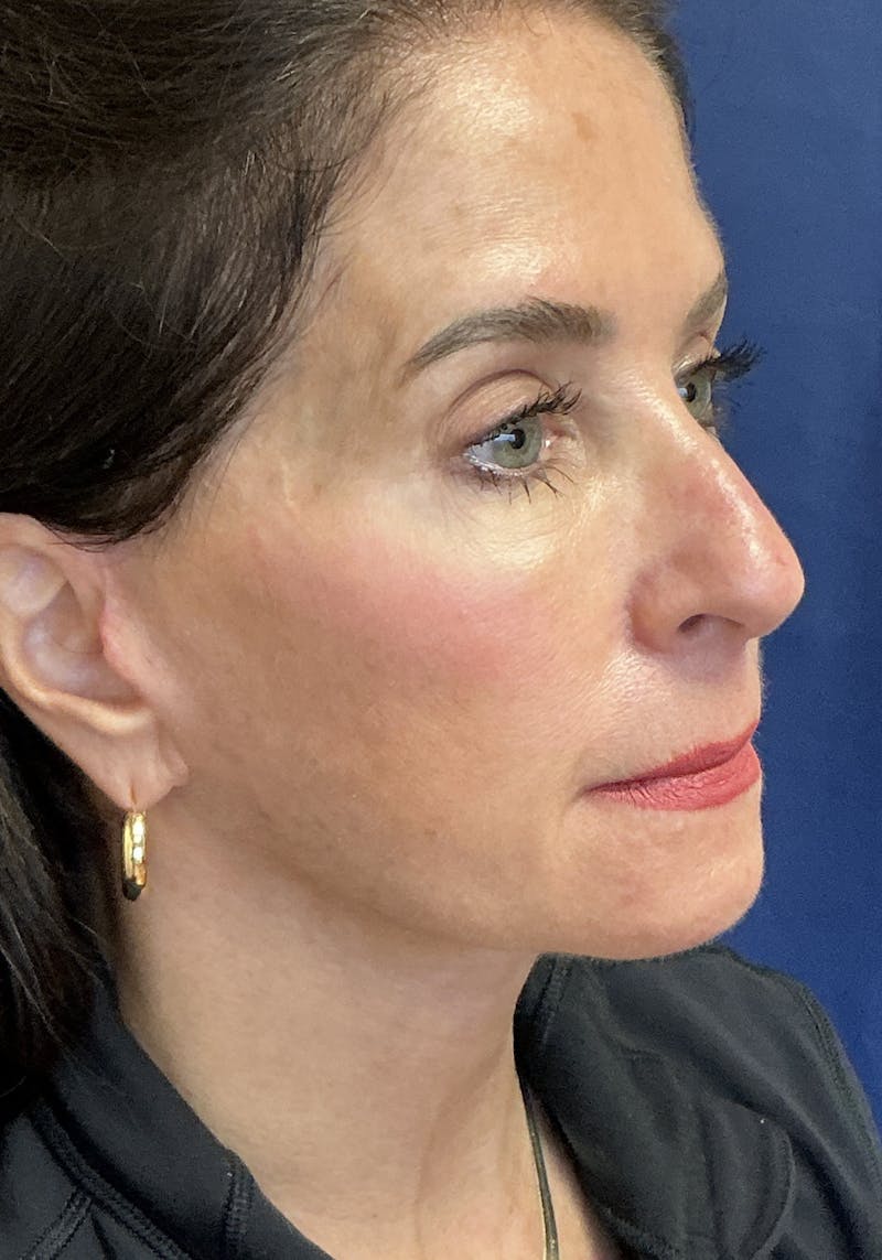 Facelift Before & After Gallery - Patient 268612 - Image 4