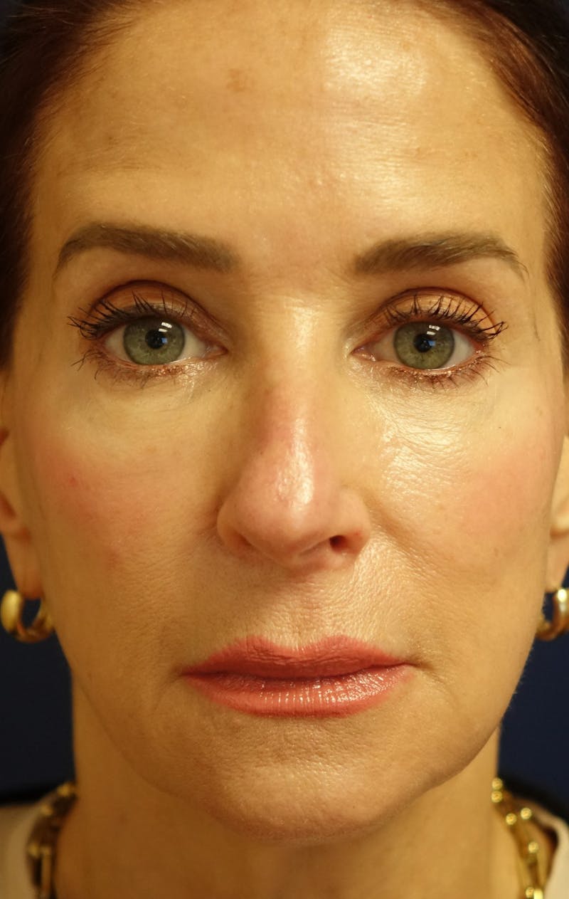 Facelift Before & After Gallery - Patient 268612 - Image 5