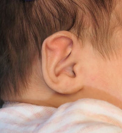 Pediatric Ear Molding Before & After Gallery - Patient 189603 - Image 1