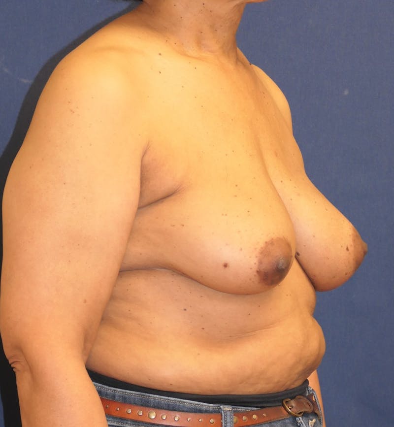 Breast Reconstruction with Implants Only Before & After Gallery - Patient 225381 - Image 4