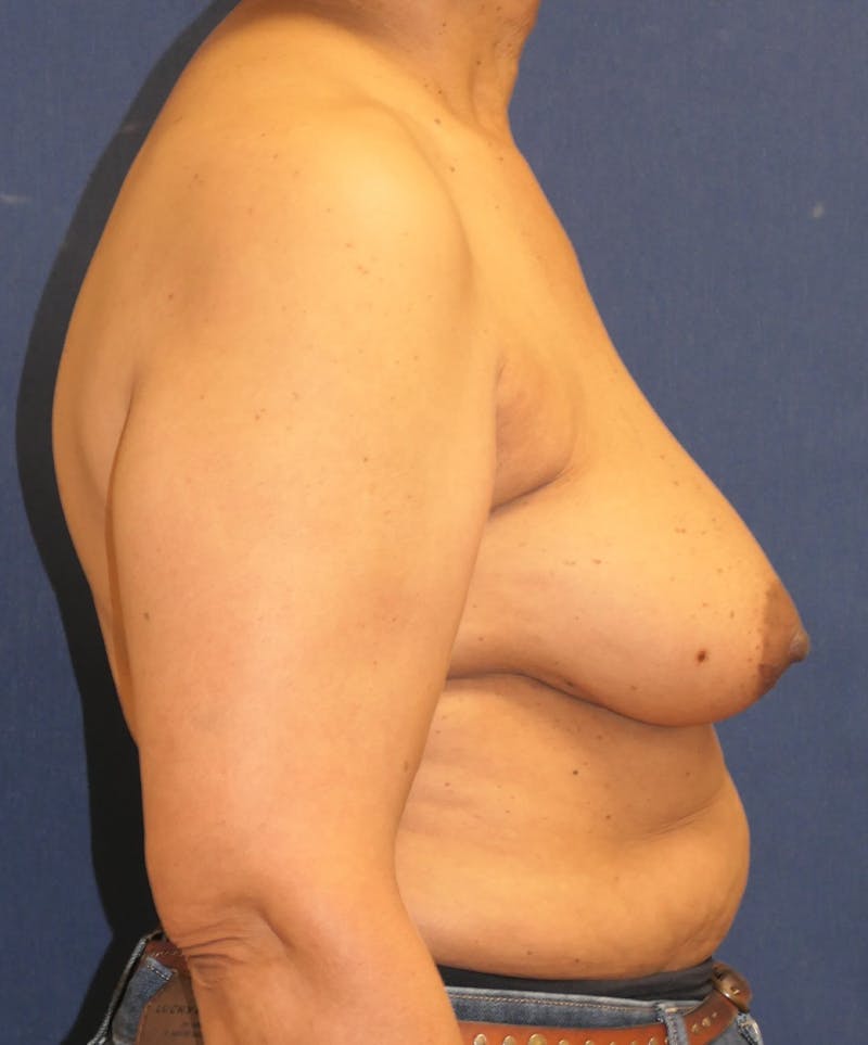 Breast Reconstruction with Implants Only Before & After Gallery - Patient 225381 - Image 6