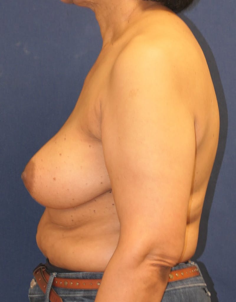 Breast Reconstruction with Implants Only Before & After Gallery - Patient 225381 - Image 10