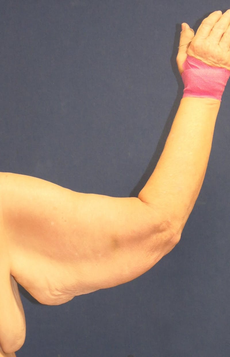 Arm Lift (Brachioplasty) Before & After Gallery - Patient 141837 - Image 1