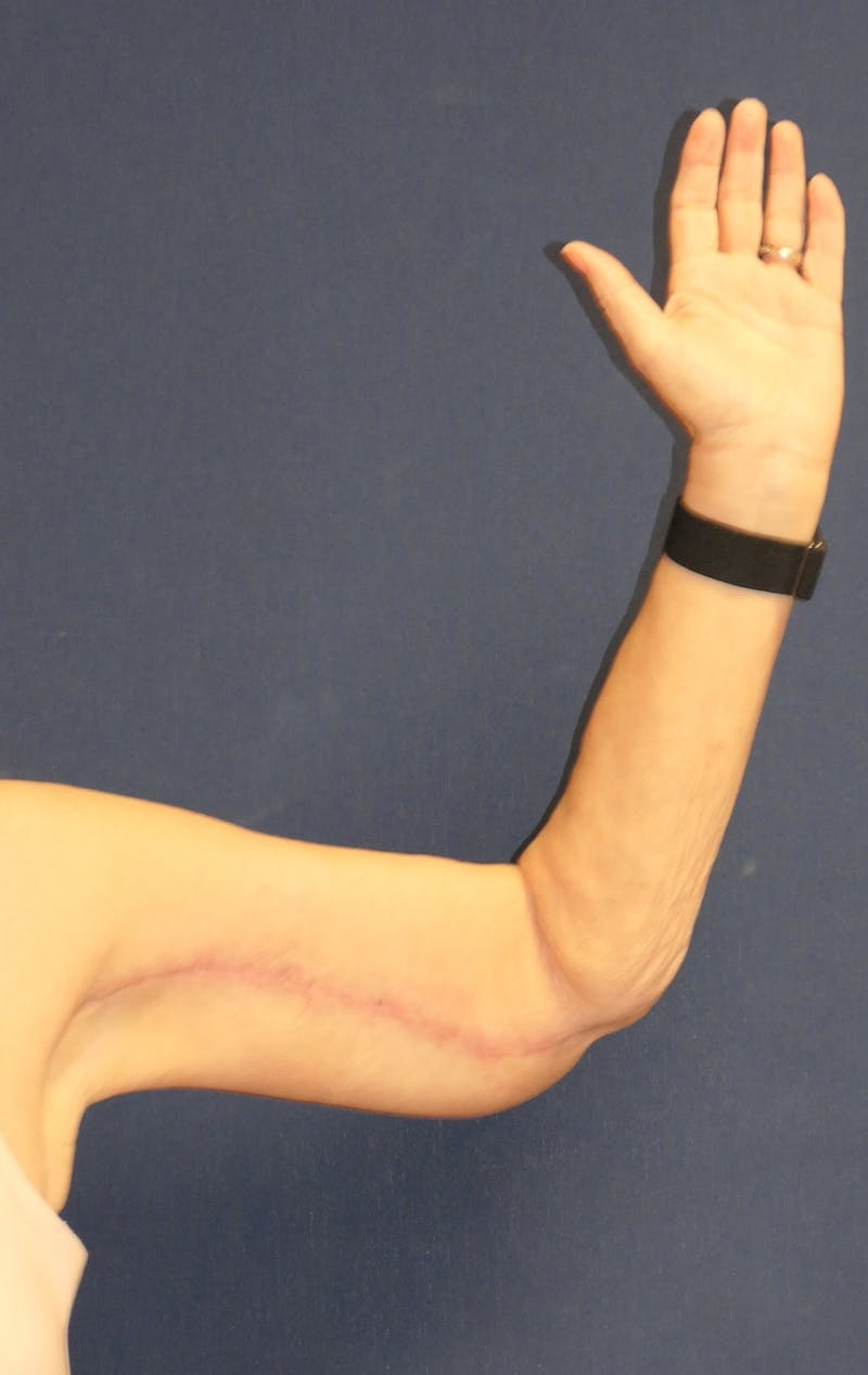Arm Lift (Brachioplasty) Before & After Gallery - Patient 141837 - Image 4