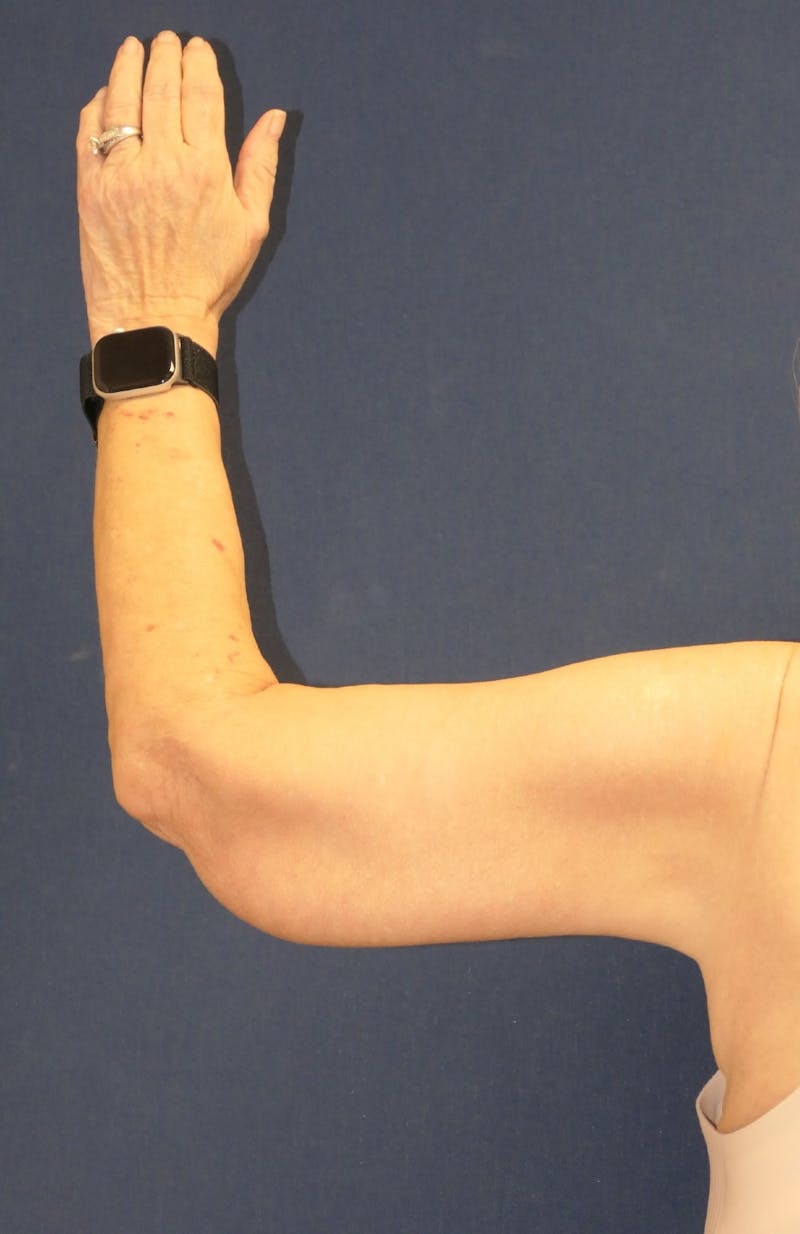 Arm Lift (Brachioplasty) Before & After Gallery - Patient 141837 - Image 6