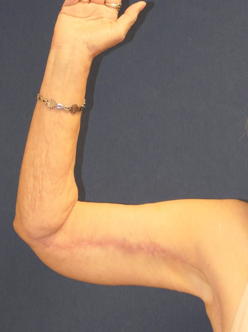 Arm Lift (Brachioplasty) Before & After Gallery - Patient 141837 - Image 8