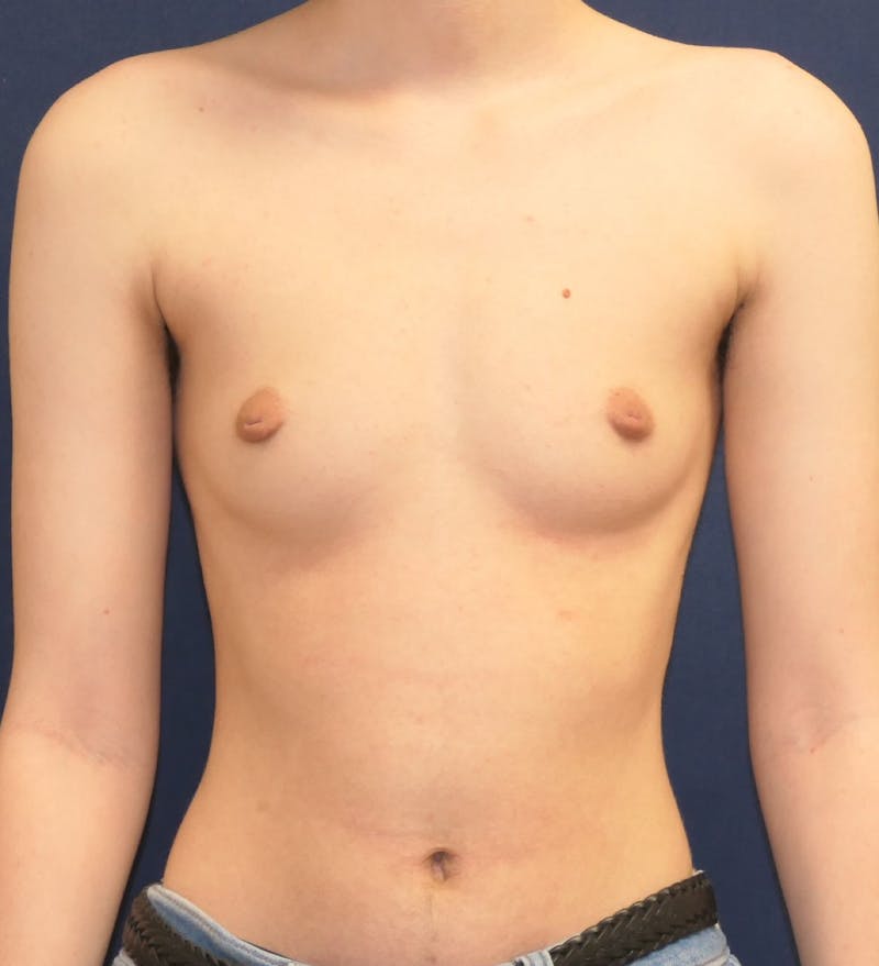 Masculinizing Surgery Before & After Gallery - Patient 279044 - Image 1