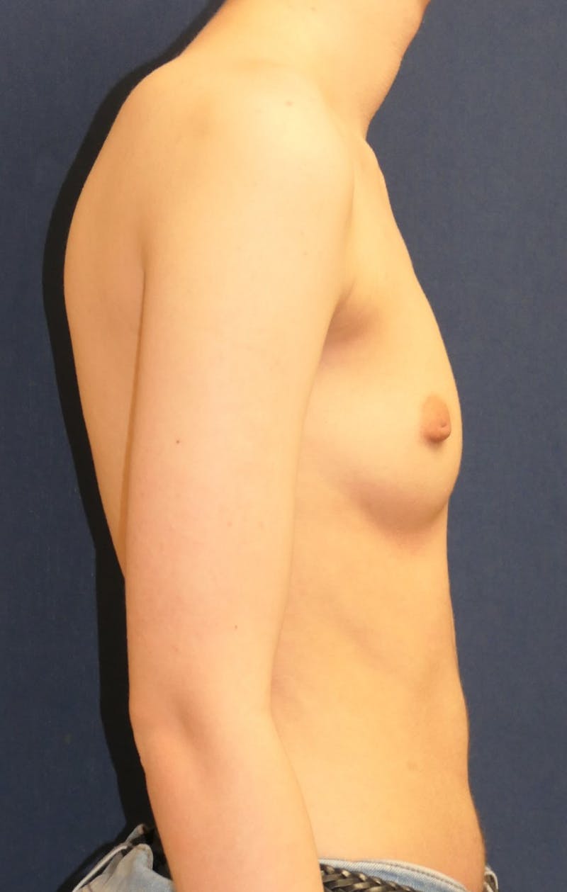 Masculinizing Surgery Before & After Gallery - Patient 279044 - Image 3
