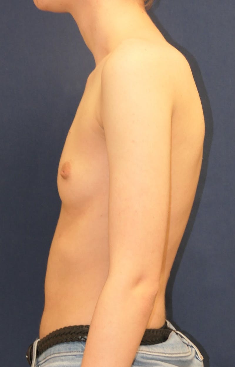 Masculinizing Surgery Before & After Gallery - Patient 279044 - Image 5