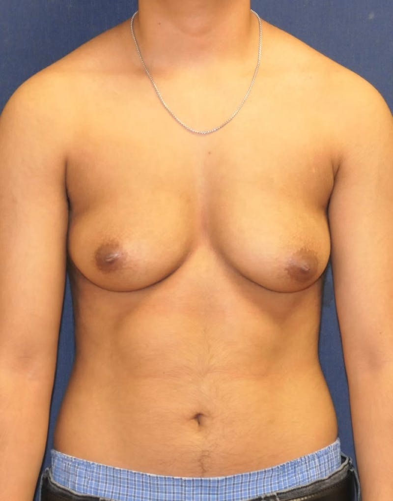 Masculinizing Surgery Before & After Gallery - Patient 230188 - Image 1
