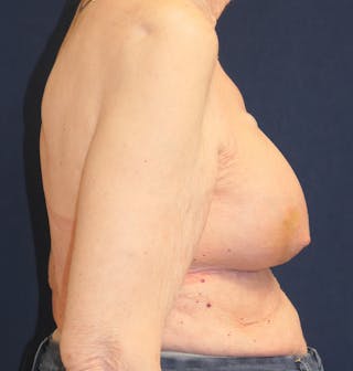Breast Reconstruction with Implants Only Before & After Gallery - Patient 273554 - Image 6