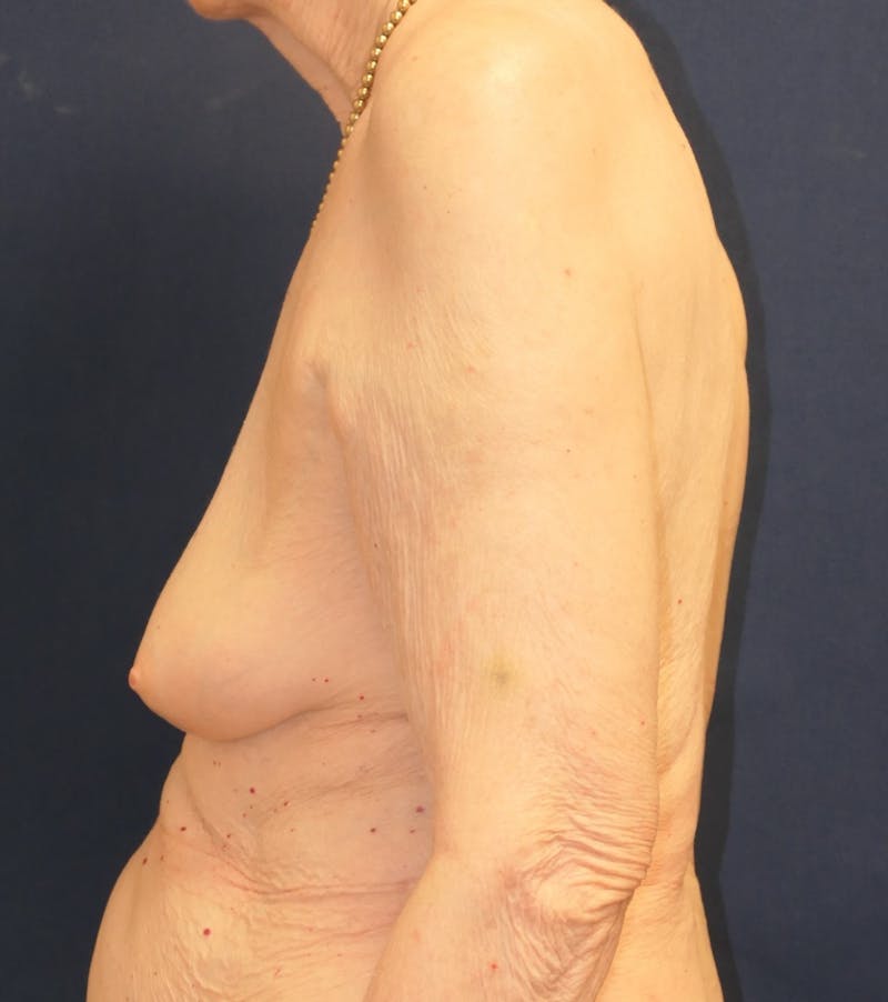Breast Reconstruction with Implants Only Before & After Gallery - Patient 273554 - Image 9