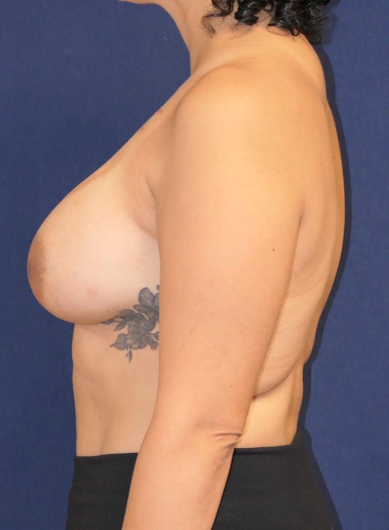 Breast Reconstruction with Implants Only Before & After Gallery - Patient 303264 - Image 10
