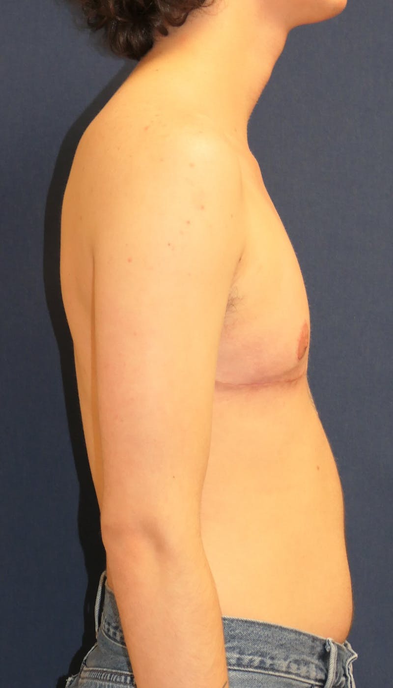 Masculinizing Surgery Before & After Gallery - Patient 819288 - Image 4