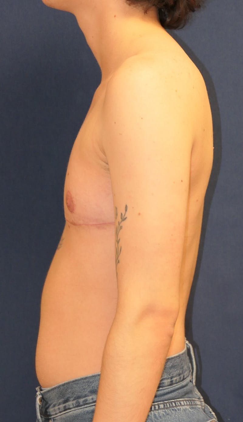 Masculinizing Surgery Before & After Gallery - Patient 819288 - Image 6