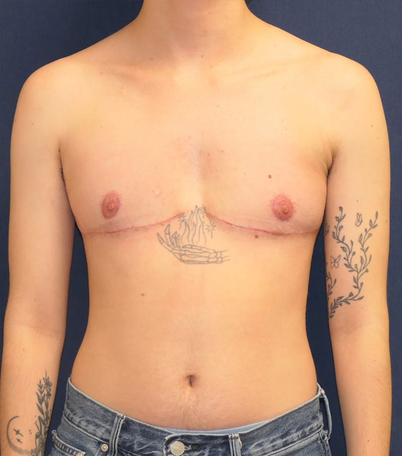Masculinizing Surgery Before & After Gallery - Patient 819288 - Image 2