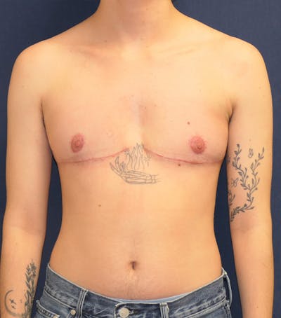 Masculinizing Surgery Before & After Gallery - Patient 819288 - Image 2