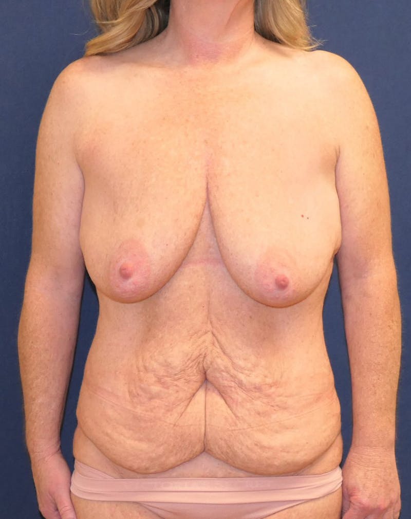 Breast Augmentation Before & After Gallery - Patient 317857 - Image 1