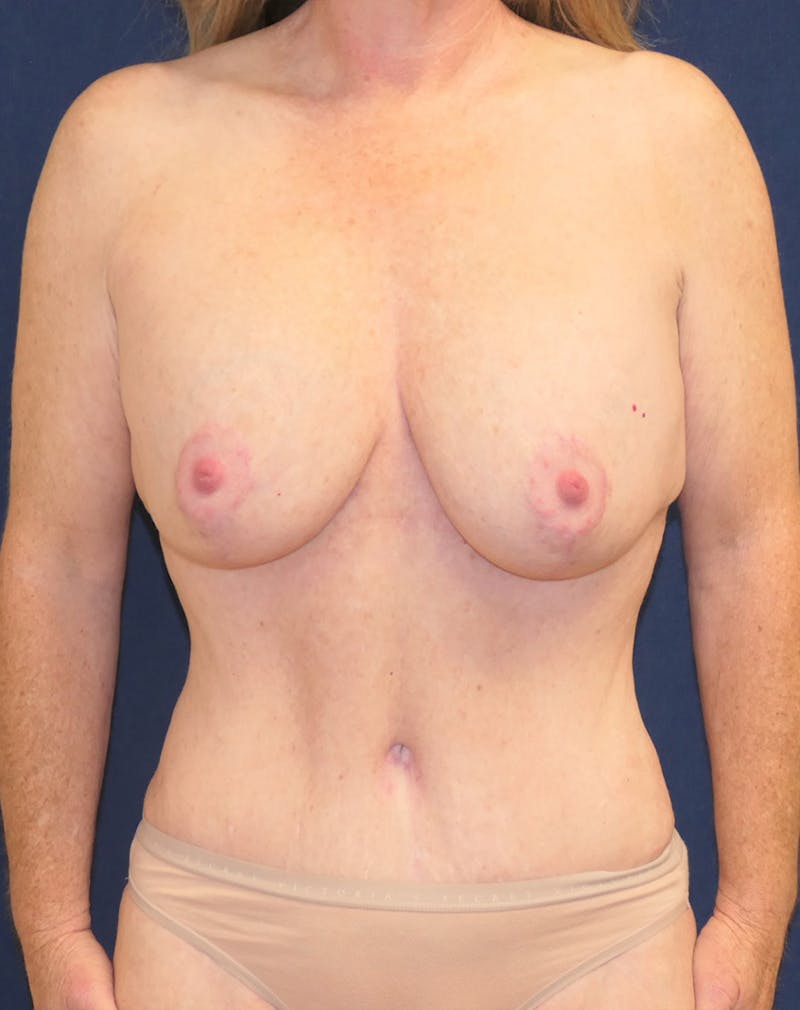 Breast Augmentation Before & After Gallery - Patient 317857 - Image 2