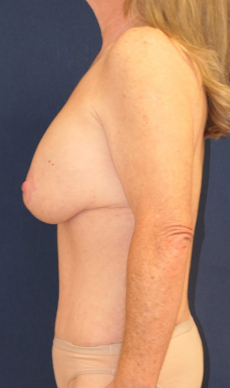 Breast Augmentation Before & After Gallery - Patient 317857 - Image 4