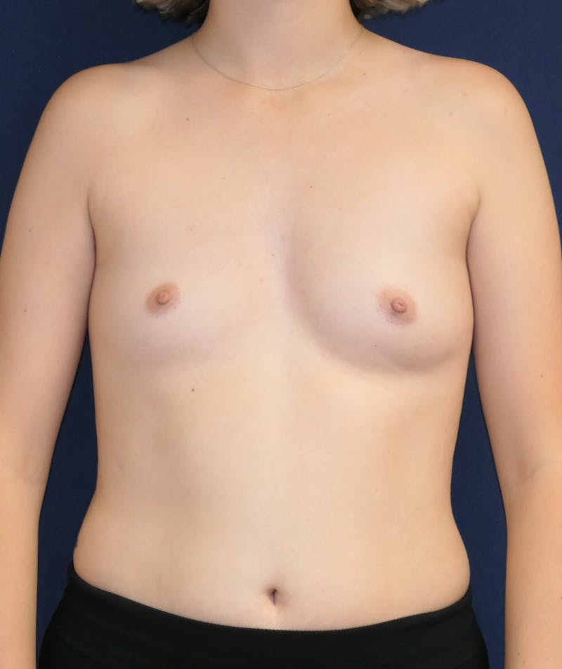 Breast Augmentation Before & After Gallery - Patient 201427 - Image 1