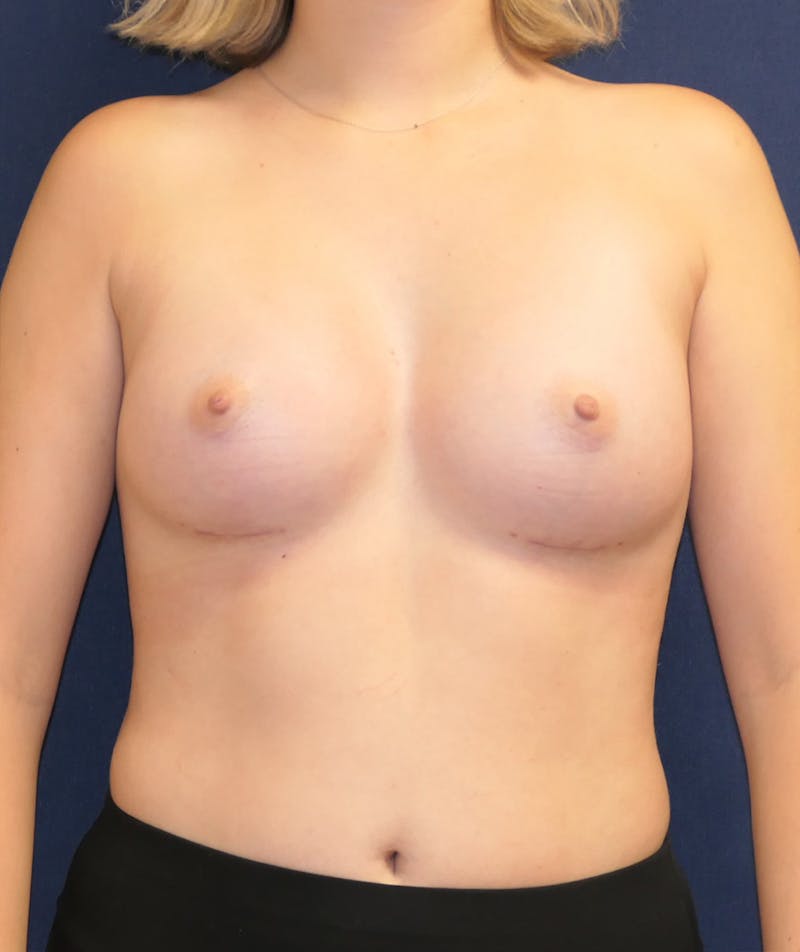 Breast Augmentation Before & After Gallery - Patient 201427 - Image 2