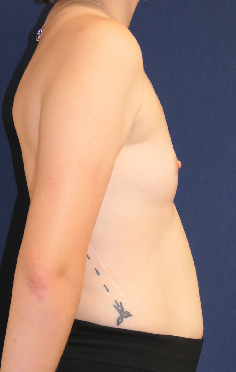 Breast Augmentation Before & After Gallery - Patient 201427 - Image 5