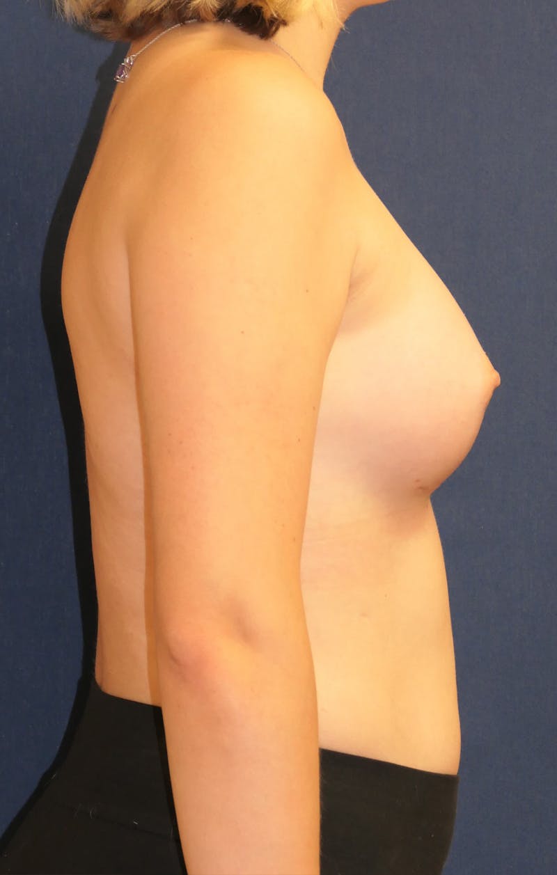 Breast Augmentation Before & After Gallery - Patient 201427 - Image 6