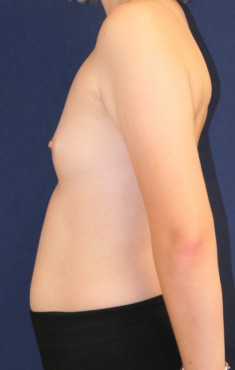 Breast Augmentation Before & After Gallery - Patient 201427 - Image 9
