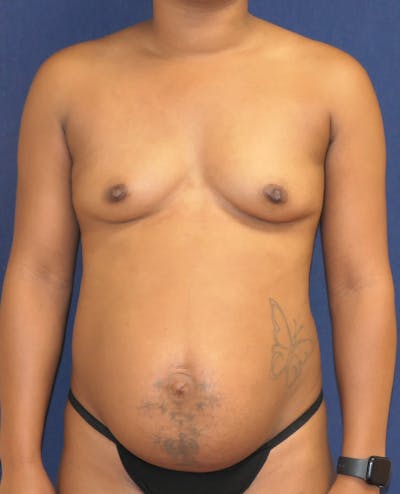 Breast Augmentation Before & After Gallery - Patient 788418 - Image 1
