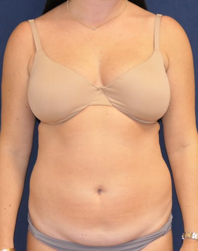 Liposuction Before & After Gallery - Patient 318372 - Image 1