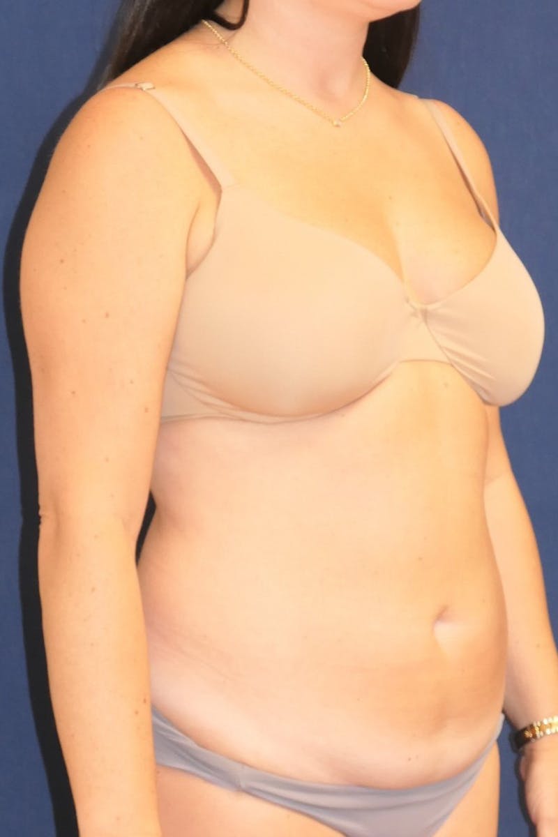 Tummy Tuck (Abdominoplasty) Before & After Gallery - Patient 246237 - Image 3