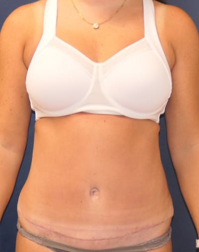 Liposuction Before & After Gallery - Patient 318372 - Image 2