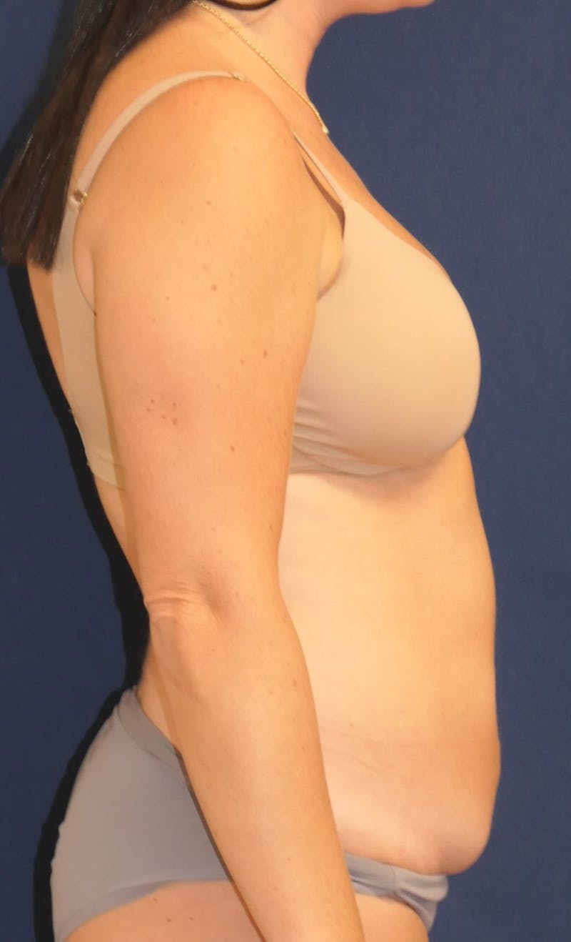 Tummy Tuck (Abdominoplasty) Before & After Gallery - Patient 246237 - Image 5