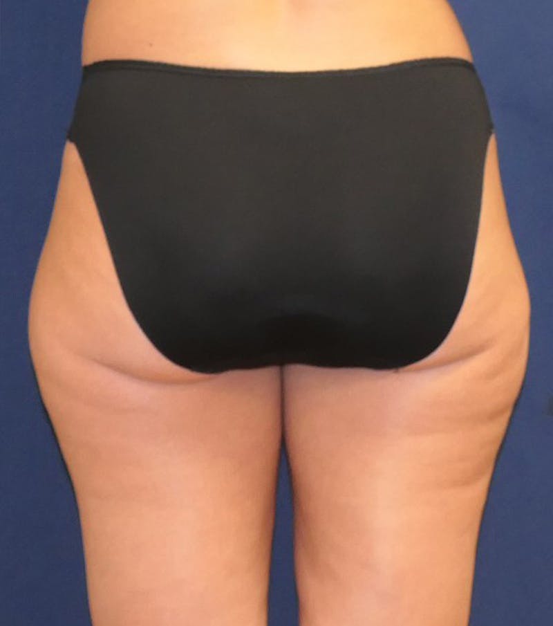 Liposuction Before & After Gallery - Patient 360939 - Image 3