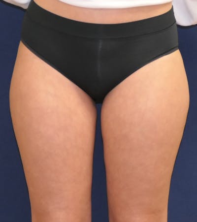 Liposuction Before & After Gallery - Patient 318763 - Image 1
