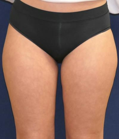 Liposuction Before & After Gallery - Patient 281338 - Image 1