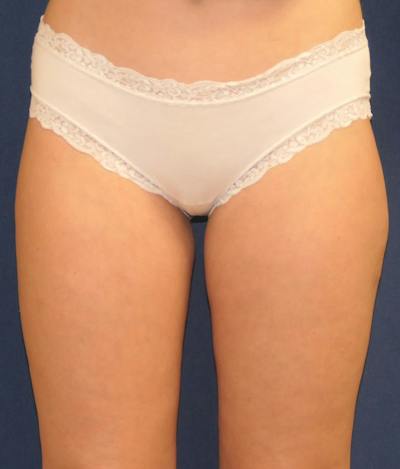 Liposuction Before & After Gallery - Patient 281338 - Image 2