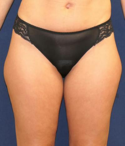 Liposuction Before & After Gallery - Patient 360939 - Image 1