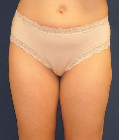 Liposuction Before & After Gallery - Patient 360939 - Image 2