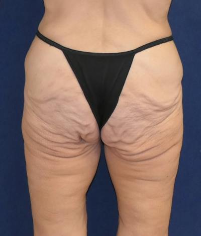 Body Lift Before & After Gallery - Patient 670398 - Image 1