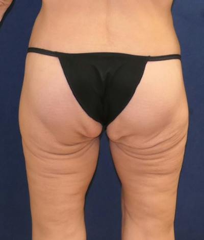 Body Lift Before & After Gallery - Patient 670398 - Image 2