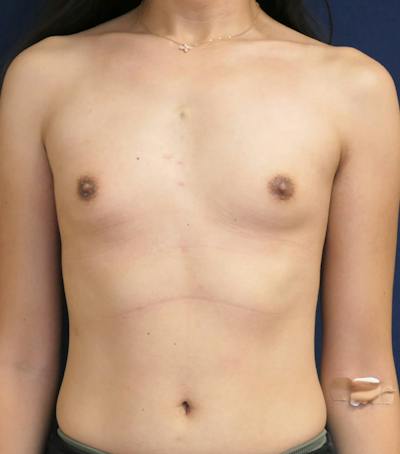 Breast Augmentation Before & After Gallery - Patient 237981 - Image 1