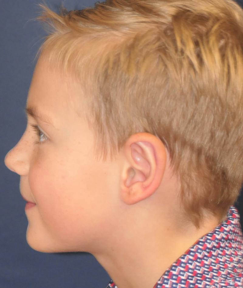 Ear Pinning (Otoplasty) Before & After Gallery - Patient 538315 - Image 8